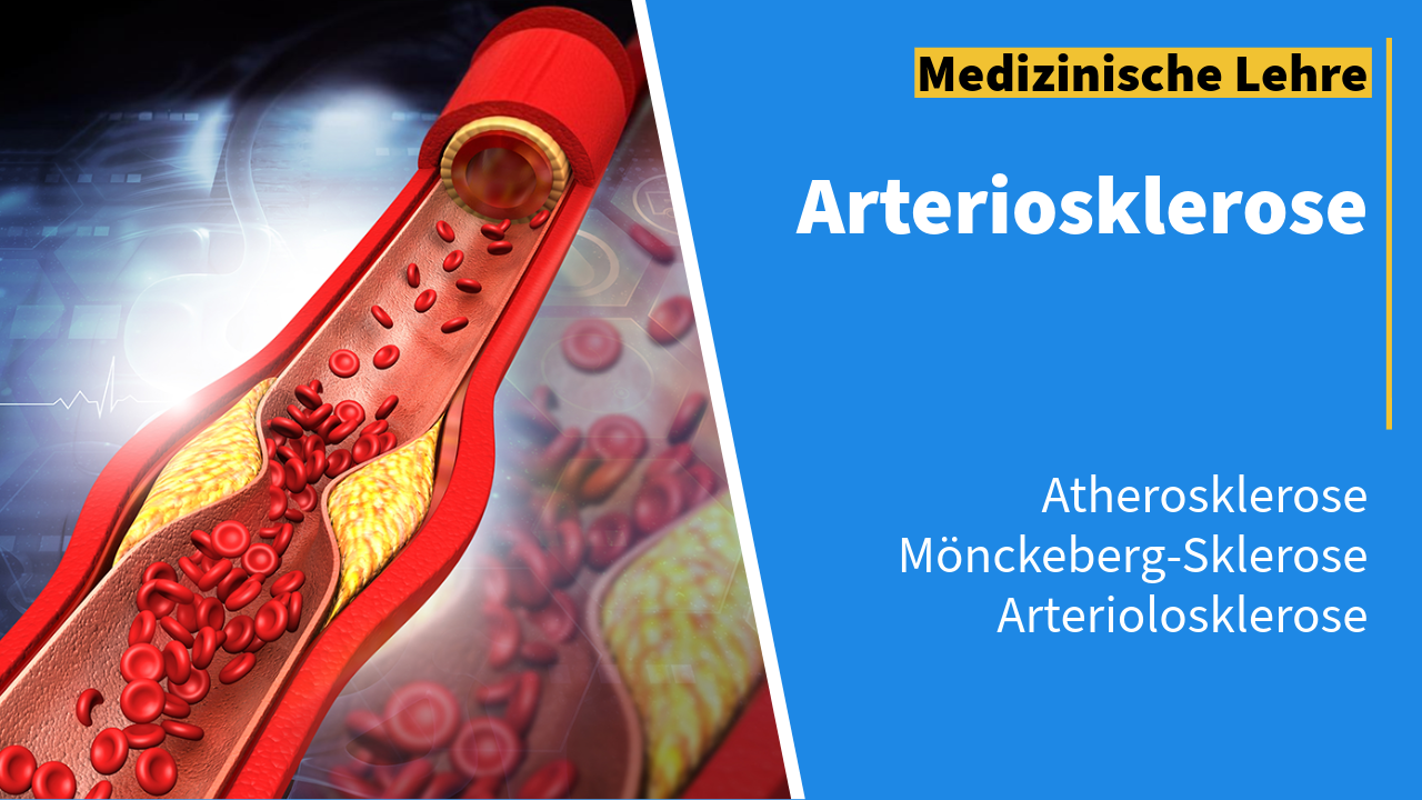 Illustration einer verengten Arterie, die durch arteriosklerotische Plaques blockiert ist, mit roten Blutkörperchen im Inneren. Auf der rechten Seite des Bildes steht der Text "Medizinische Lehre Arteriosklerose" vor einem blauen Hintergrund, zusammen mit den Begriffen "Atherosklerose", "Mönckeberg-Sklerose" und "Arteriolosklerose".